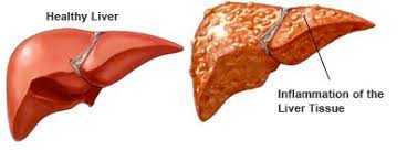 Berbagai Macam Virus Penyebab Penyakit Radang Hati Seruji